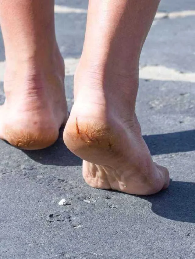 get-rid-of-cracked-heels-1762062295